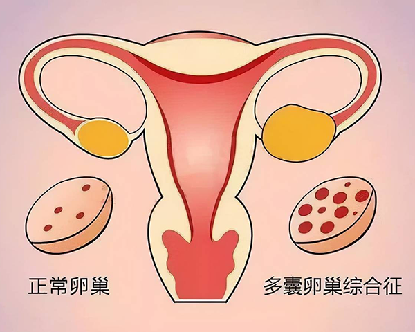 多囊卵巢综合症会引起不孕不育