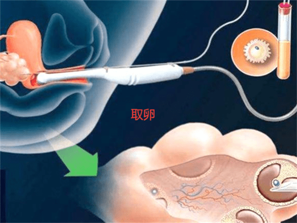 试管取卵前不一定要住院